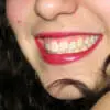 Los beneficios de los implantes dentales