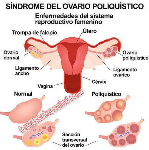 El Síndrome de ovario poliquístico es un trastorno endocrino