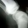 El uso de terapias combinadas para la osteoporosis