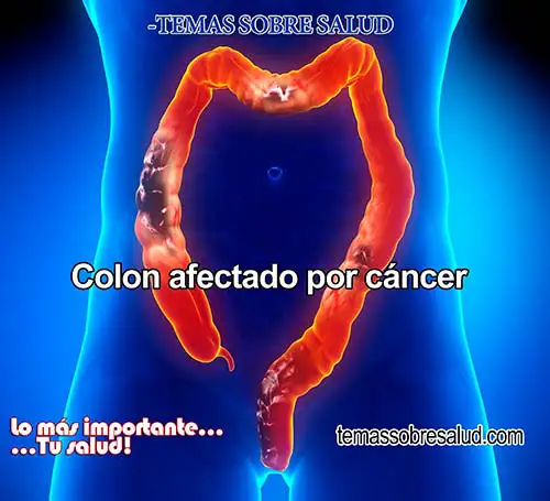 síntomas que pueden indicar la existencia de cáncer de colon