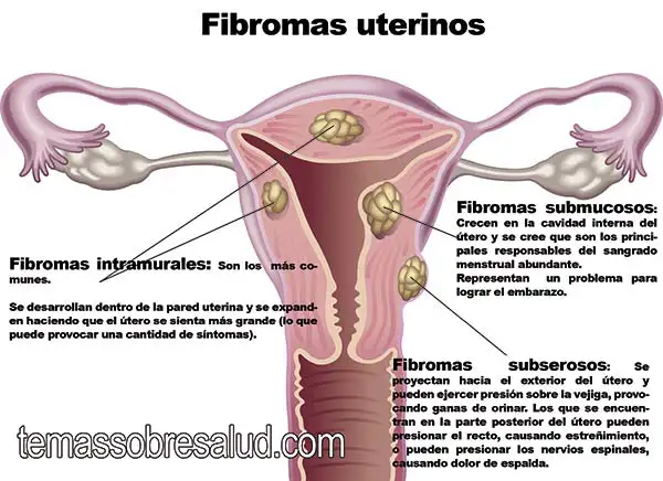 La diferencia entre los fibromas y pólipos infertilidad