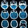 Etapas de la enfermedad de Alzheimer hay dificultades con aritméticas simples.