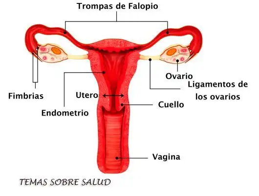 Fibromas ováricos - Dolor de ovarios
