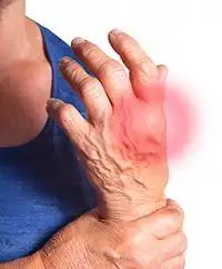 la artritis
