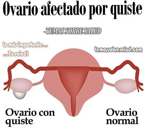 El Síndrome de ovario poliquístico es un trastorno endocrino