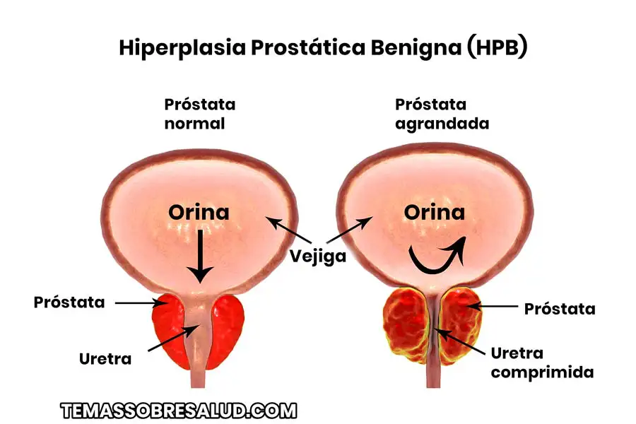 Agrandamiento de la próstata: un problema frecuente