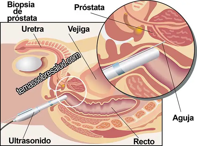 Prevenir El Cáncer de Próstata