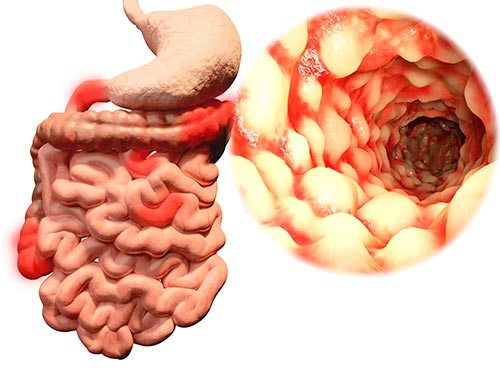 Dolor abdominal del cuadrante superior izquierdo enfermedad de Crohn