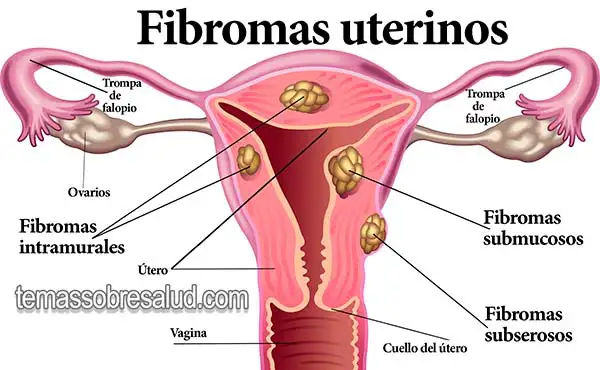 ¿Qué son los fibromas uterinos?