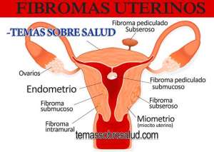 ¿Qué son los fibromas uterinos?