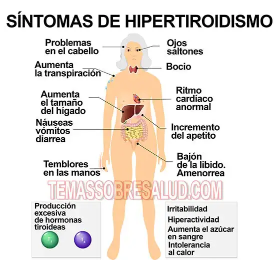 Hipertiroidismo causado por la enfermedad de Hashimoto - Ablación con radioyodo