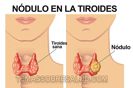 Cáncer de glándula tiroides Folicular