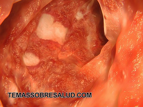 Enfermedades inflamatorias Crohn y colitis ulcerosa