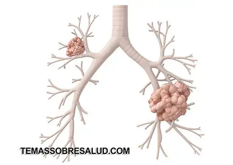 mucosidad El tipo más común de cáncer de pulmón en las mujeres es el adenocarcinoma