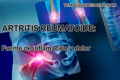 Los síntomas de la artritis reumatoide mejoran con la actividad física