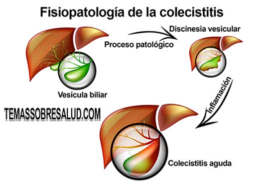 La eliminación de la vesícula biliar causa problemas metabólicos y digestivos como dolor estomacal