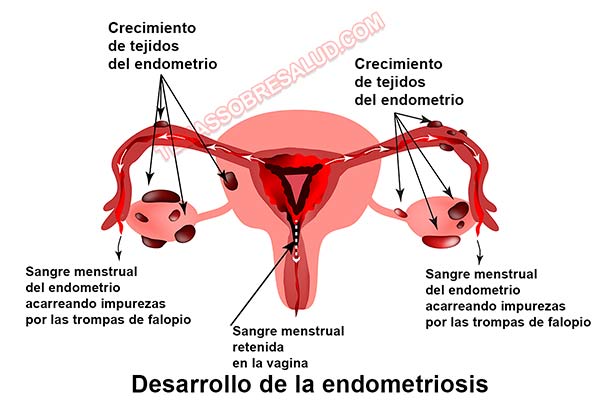 Comunes de la infertilidad - endometriosis