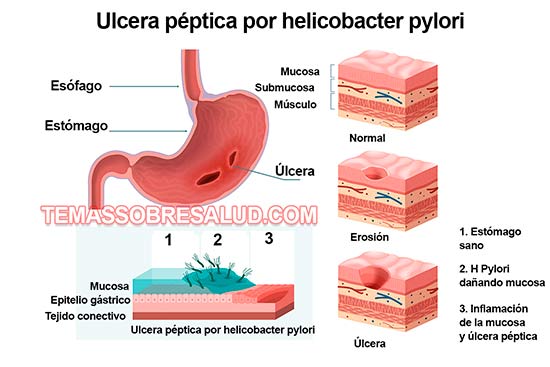 úlcera duodenal - Dolor abdominal infecciones por H Pylori