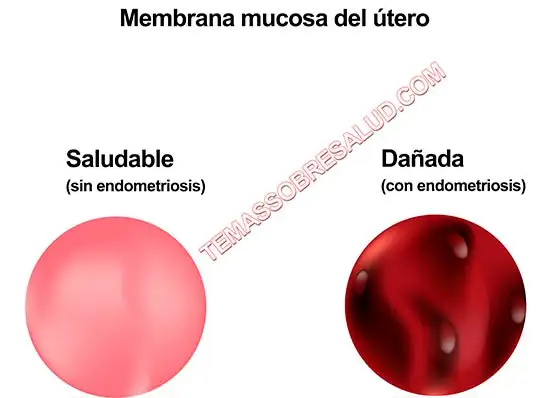 Infertilidad por endometriosis