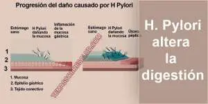 infecciones por H Pylori - retortijones