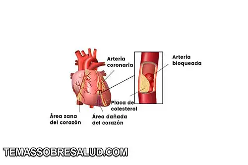 infarto de miocardio con elevación del segmento ST (IAMCEST)