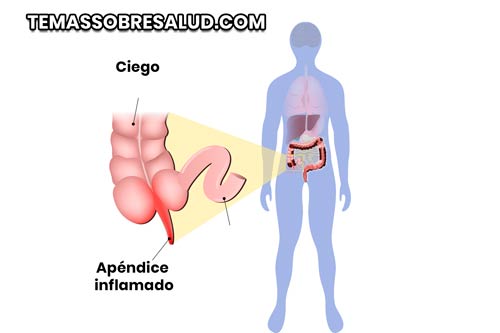 el primer signo de apendicitis suele ser dolor alrededor del ombligo