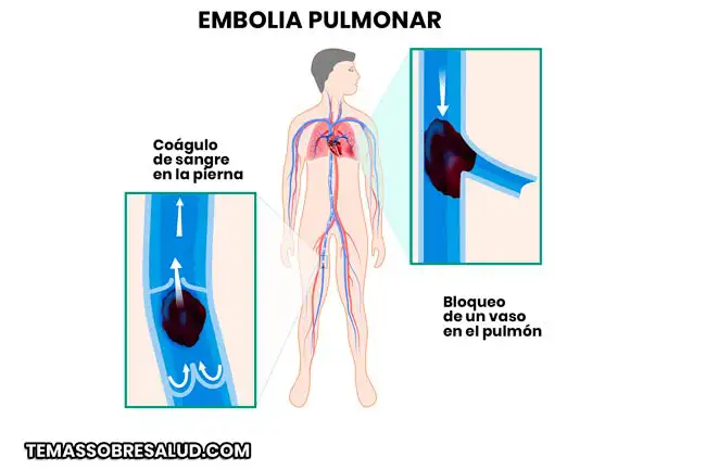 Angiografía pulmonar para el diagnostico de la embolia pulmonar