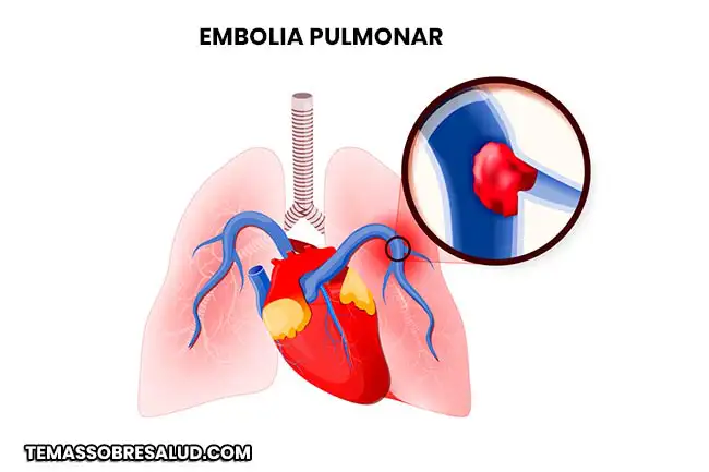 la embolia pulmonar es común