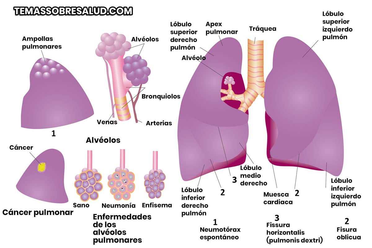 Enfisema pulmonar por aumento de la presión en los pulmones