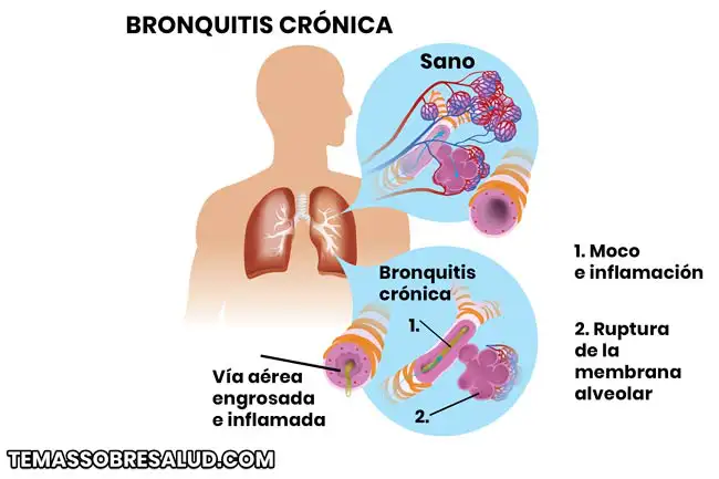 Bronquitis obstructiva en los niños