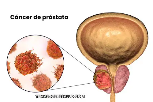 ¿cómo se indica el grado de malignidad del cáncer de próstata?