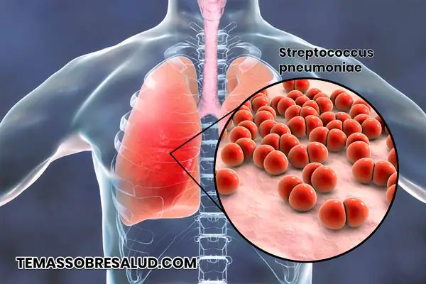 Choque séptico por bacterias de infección pulmonar bacteriana que ingresan al torrente sanguíneo.