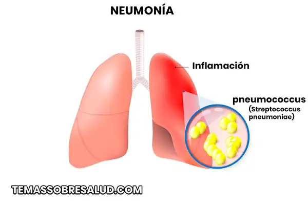 La neumonía bacteriana puede ser causada por tuberculosis o por bacteria Mycoplasma pneumoniae