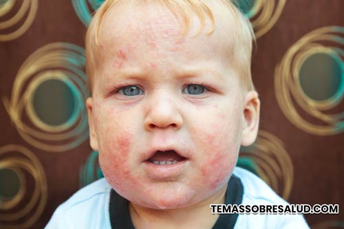 Enfermedades y síntomas causados ​​por la alergia al polvo doméstico