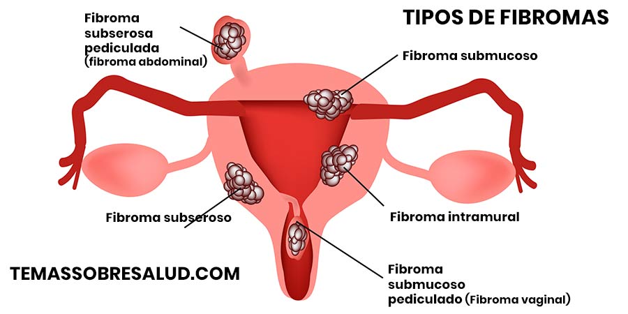 Los fibromas ováricos se extirpan mediante cirugía, a menudo junto con el ovario afectado.
