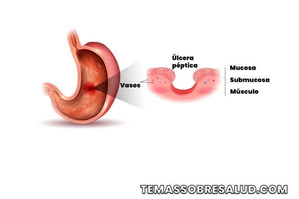 Tratamiento de la enfermedad de úlcera péptica