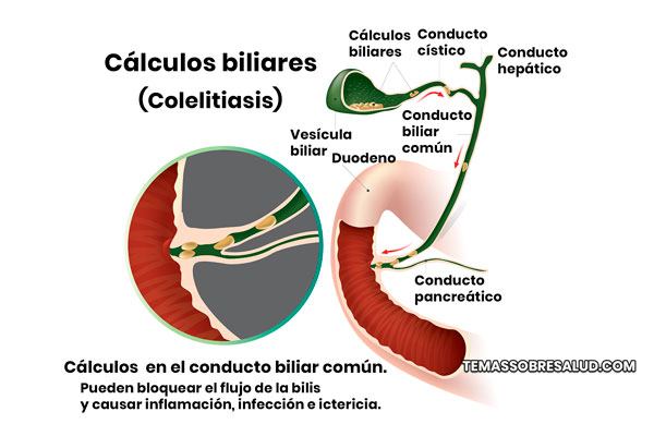 Enfermedades de la vesícula biliar discinesia biliar