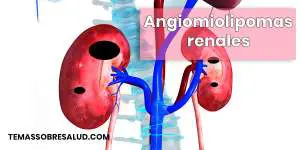 Angiomiolipomas renales