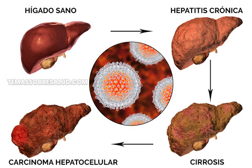 hígado con carcinoma hepatocelular
