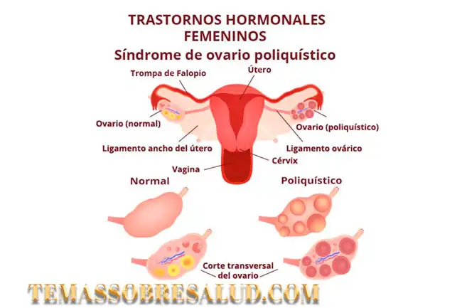 Síndrome de ovario poliquístico SOP